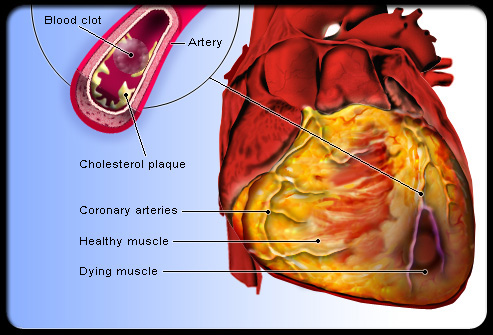 heart attack. heart disease is the